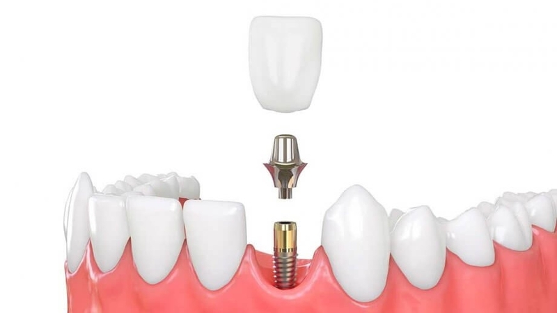 Giải đáp chi phí trồng 2 răng cửa giá bao nhiêu: Trồng răng implant giá khoảng 26 triệu VNĐ