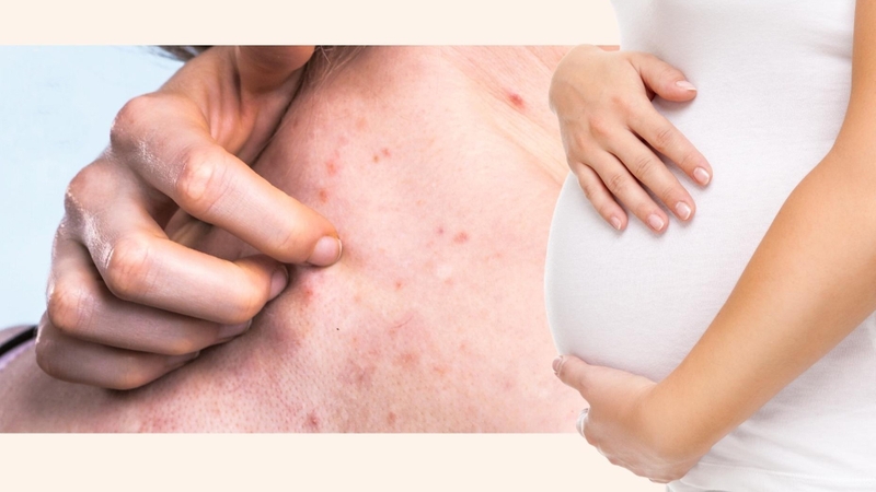 Giải đáp chi tiết: Bà bầu có được dùng kem trị mụn không - 1