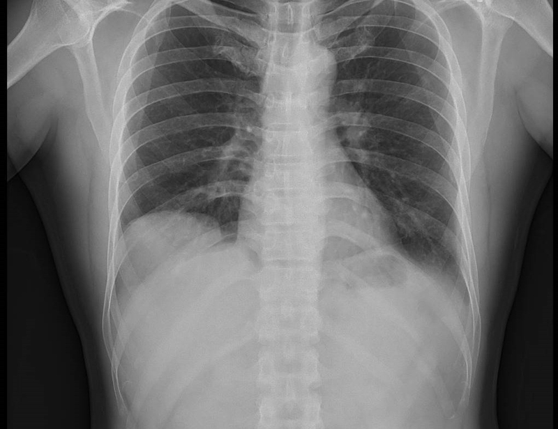 giai-dap-chup-x-quang-phoi-co-vet-mo-phan-anh-dieu-gi 2.jpg