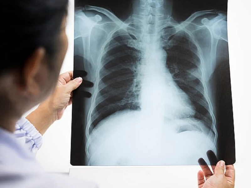 giai-dap-chup-x-quang-phoi-co-vet-mo-phan-anh-dieu-gi 3.jpg