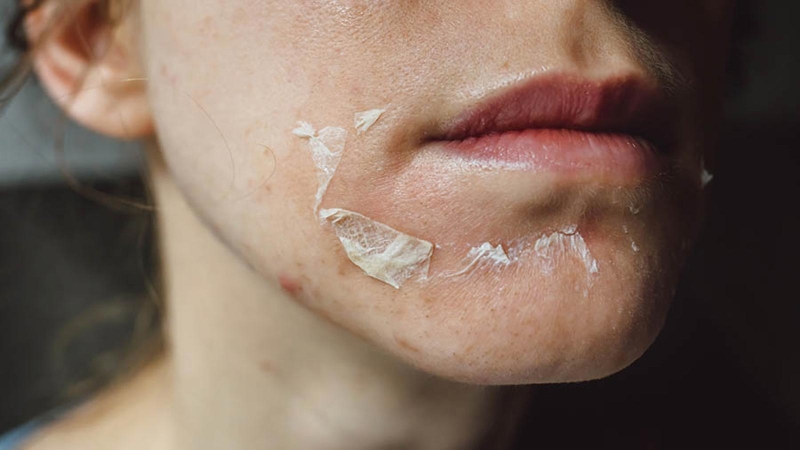 Có nên peel Glycolic Acid không? Peel da với Glycolic Acid (AHA) Đây là phương pháp giúp làm sáng da và kích thích tái tạo collagen