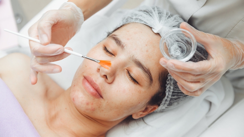 Chăm sóc da kỹ hơn sau khi thực hiện peel Glycolic Acid