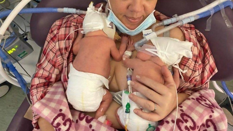 Thụ tinh song sinh có thể khiến mẹ sinh non, thiếu tháng