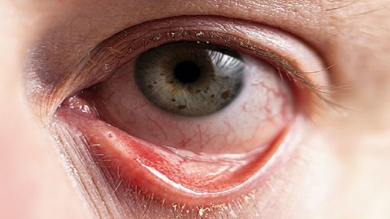 Giải đáp cùng chuyên gia: Dùng thuốc nhỏ mắt nhiều có tốt không? 2