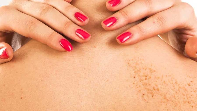 Giải đáp: Da nổi đốm nâu ngứa là bị bệnh gì? 1