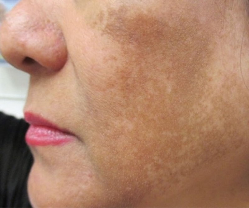 Giải đáp: Da nổi đốm nâu ngứa là bị bệnh gì? 2