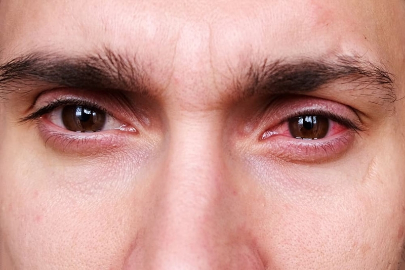 Giải đáp: Đau mắt hàn có nên nhỏ nước muối 1