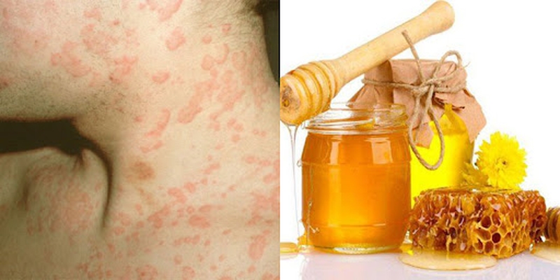 Giải đáp: Dị ứng hải sản uống nước gì? 2