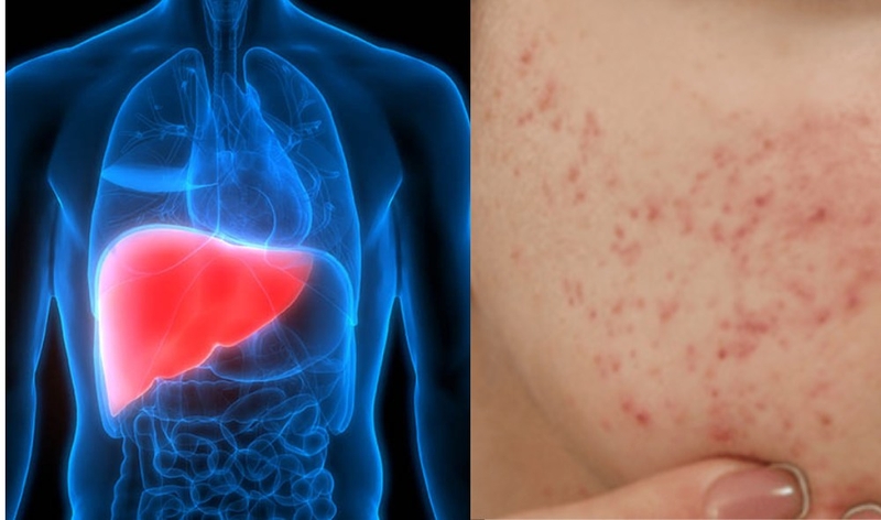 Giải đáp: Gan thải độc qua da có gây mụn không? 4