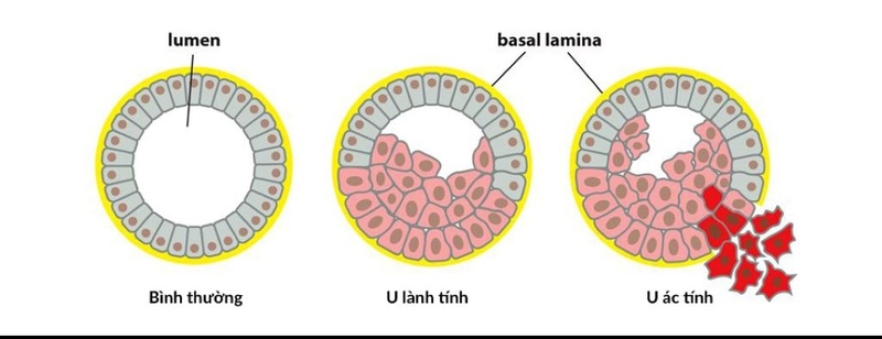 Giải đáp: Khối u đại tràng có nguy hiểm không? 3