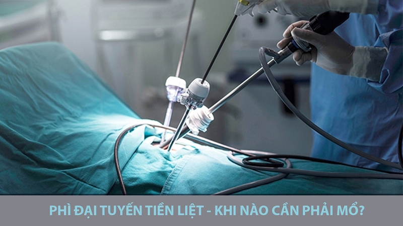 Giải đáp: Kích thước tiền liệt tuyến bao nhiêu phải mổ 2