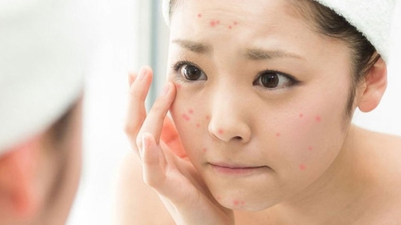 [Giải đáp] Lột mụn xong tẩy tế bào chết được không? - Hình 1