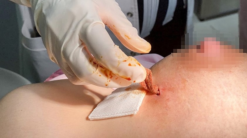 Cách phân biệt tắc tia sữa và áp xe vú sau sinh 5