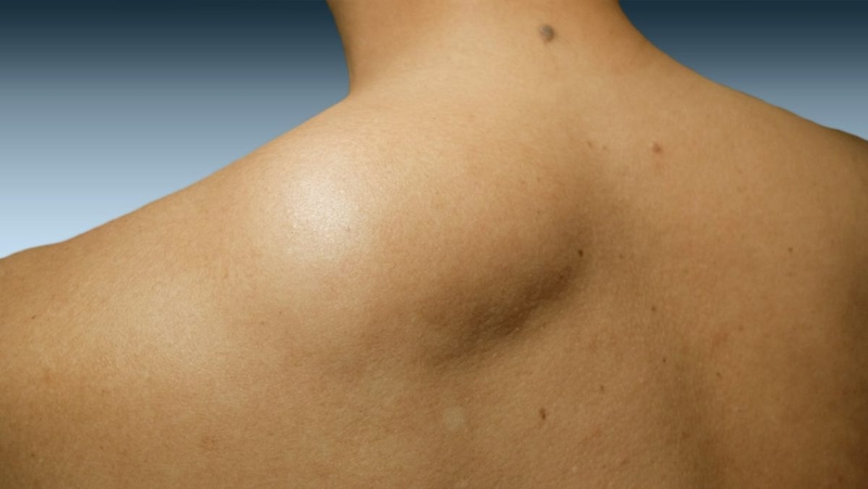 Giải đáp: Mổ bướu mỡ có nguy hiểm không? 2