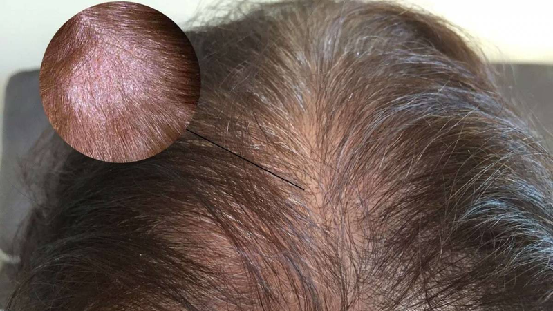 Giải đáp: Nấm da đầu có lây không? 2