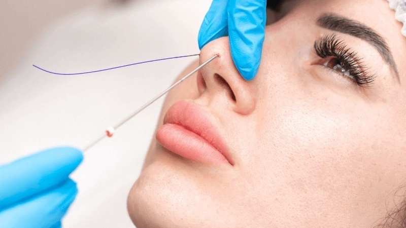 Giải đáp: Nâng mũi ăn mắm tôm được không 1