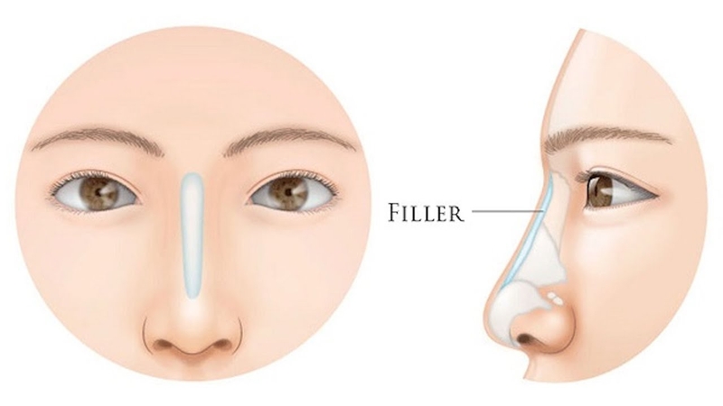 Giải đáp: Nâng mũi filler bao nhiêu tiền và có những loại filler nào 1