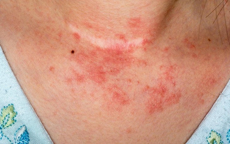 Giải đáp ngay: Bà bầu có dùng được gentrisone để trị viêm da dị ứng - 1