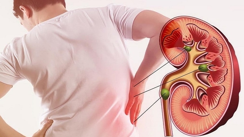 giai-dap-nguoi-bi-benh-suy-than-co-duoc-an-cam-khong 1.jpg