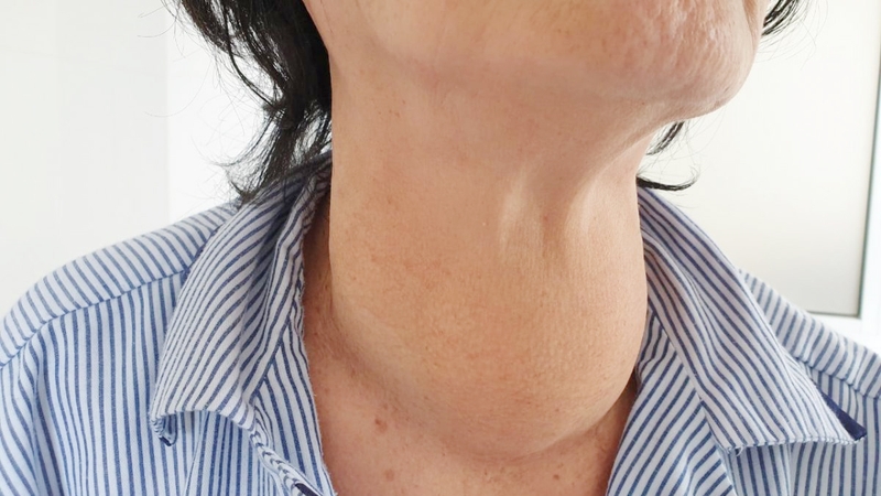 Giải đáp: Người bị bướu cổ ăn thịt bò được không?