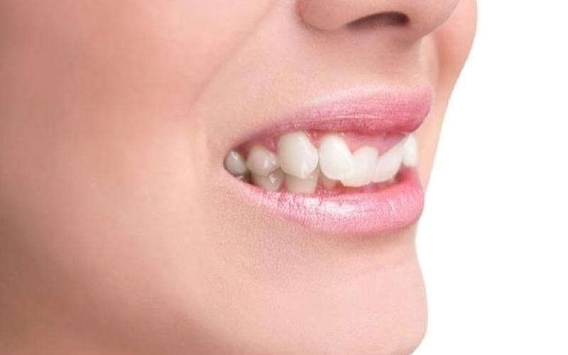 Giải đáp: Nhổ răng số 4 có bị hóp má không? 3