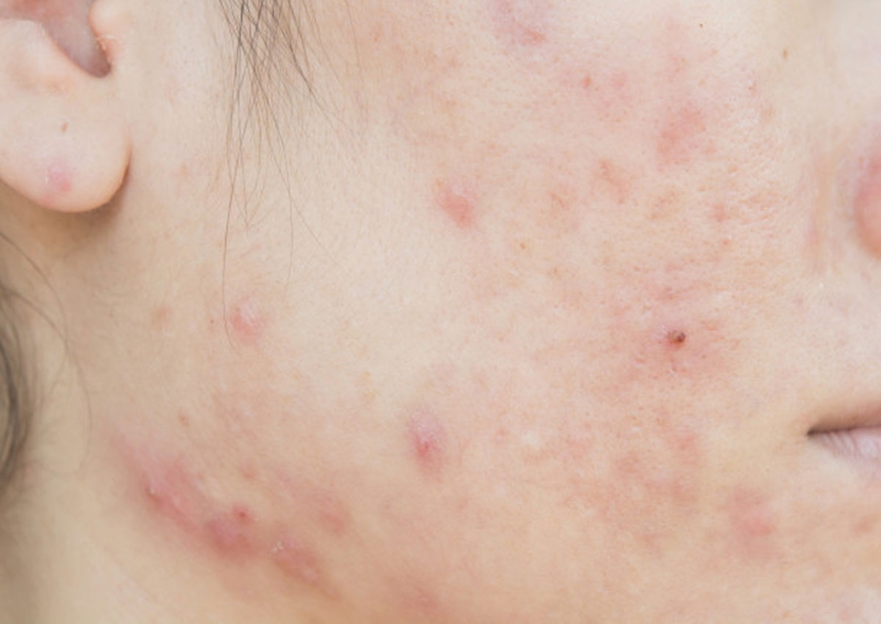 Giải đáp những thắc mắc về lăn kim trị mụn và lưu ý sau khi điều trị 2