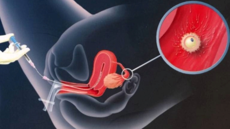 Thụ tinh nhân tạo là phương pháp hỗ trợ sinh sản được đánh giá cao hiện nay