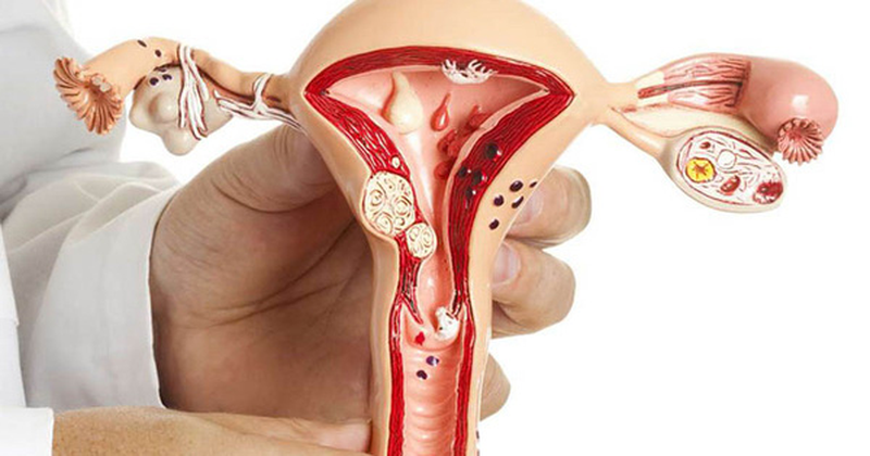 Giải đáp: Polyp lòng tử cung có mang thai được không? 3