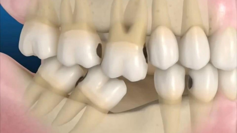 Giải đáp răng bị nghiêng có niềng được không? 1