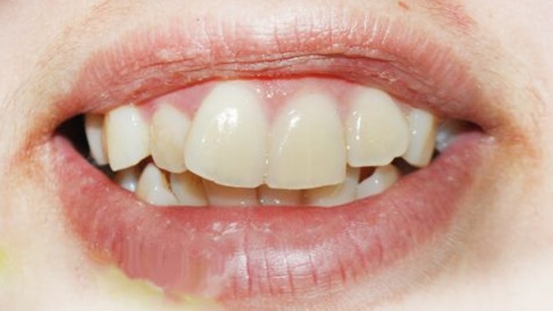 Giải đáp răng bị nghiêng có niềng được không? 2