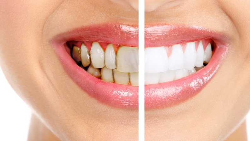 giai-dap-rang-su-co-tay-trang-duoc-khong 2.jpg