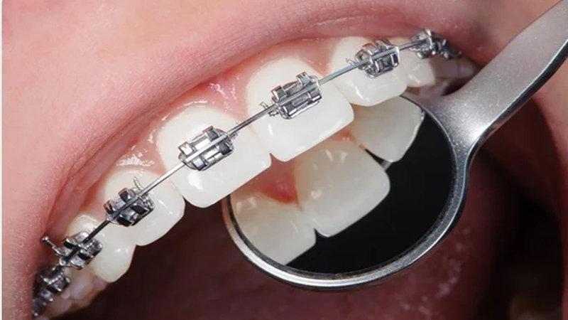 Giải đáp: Răng yếu có niềng được không? 1