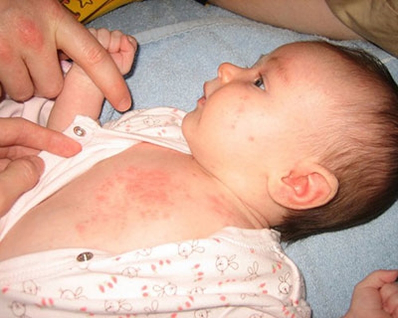 Giải đáp: sởi có ngứa không 1