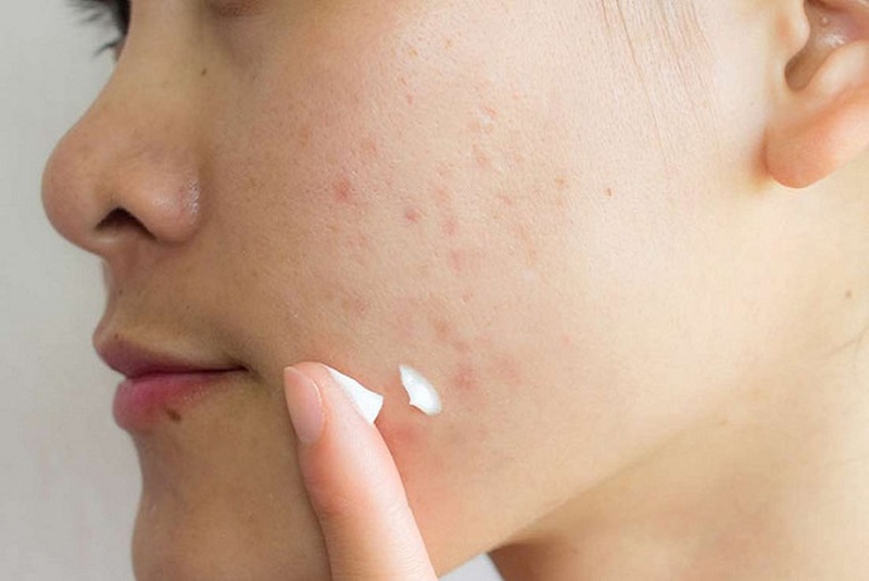 Giải đáp: Tẩy nốt ruồi bao lâu thì bôi kem trị sẹo? 2
