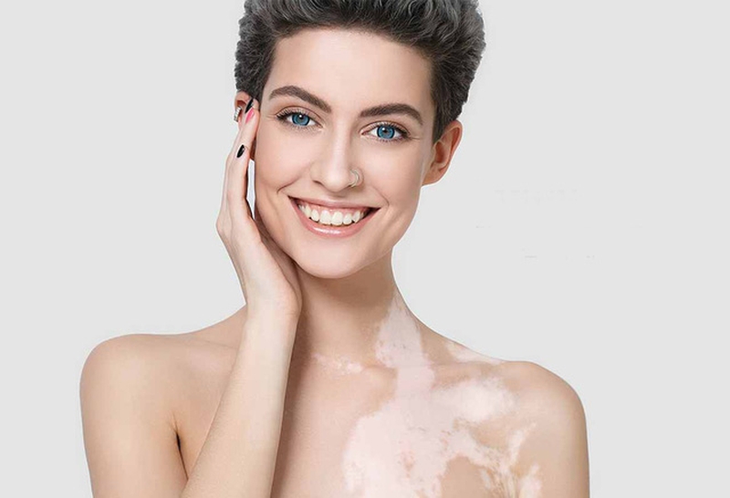 Một số nguyên nhân gây ra bệnh bạch biến