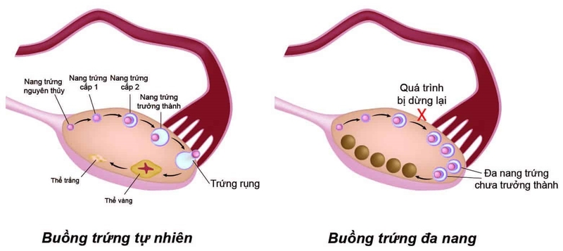 Giải đáp thắc mắc: Bệnh đa nang buồng trứng uống OvaQ1 để có con được không?