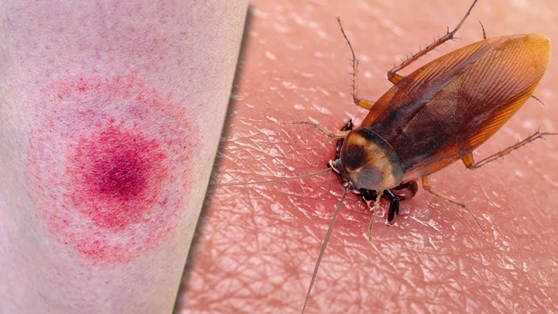 Giải đáp thắc mắc: Bị gián cắn có sao không? 2