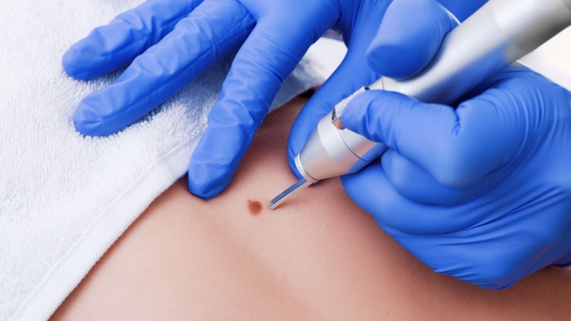 giai-dap-thac-mac-bi-sui-mao-ga-co-hien-mau-duoc-khong 3.jpg