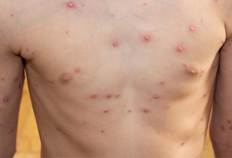 Giải đáp thắc mắc: Bị thuỷ đậu có nên tắm nước muối không? 1