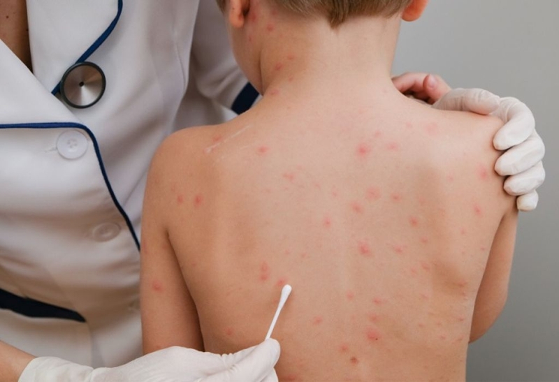 Giải đáp thắc mắc: Bị thuỷ đậu có nên tắm nước muối không? 4