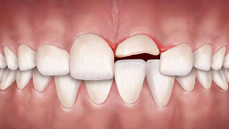 Giải đáp thắc mắc: Cho con bú có lấy tủy răng được không 2