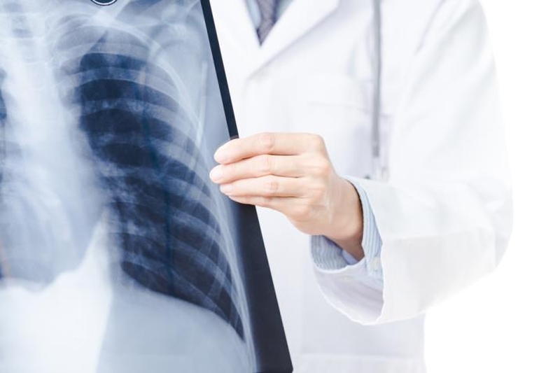 Giải đáp thắc mắc “Chụp X-quang có phát hiện ung thư phổi không?”