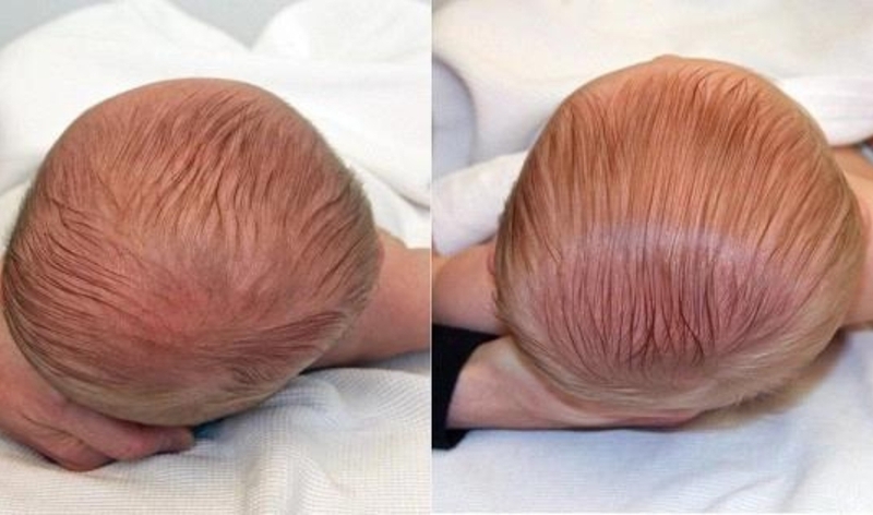 Giải đáp thắc mắc: Có nên cho trẻ sơ sinh nằm gối hay không? 2