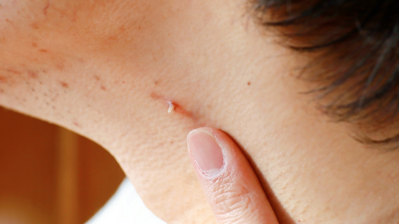 Vắc xin HPV giúp giảm đáng kể nguy cơ sùi mào gà và ung thư sinh dục, nhưng không loại bỏ hoàn toàn