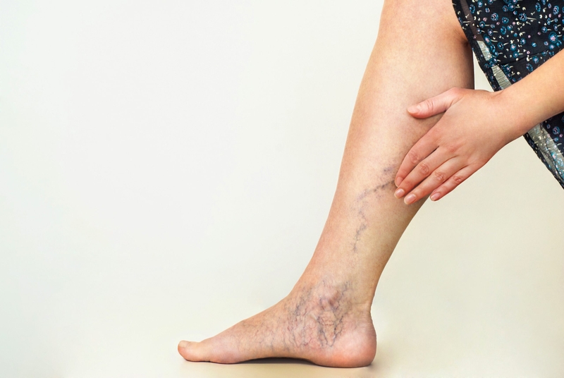 Giải đáp thắc mắc: Giãn tĩnh mạch nông chi dưới là gì? 2