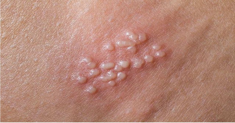 giai-dap-thac-mac-giang-mai-va-sui-mao-ga-co-giong-nhau-khong 1.jpg