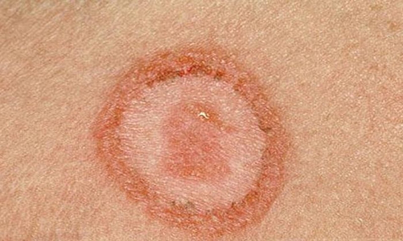 giai-dap-thac-mac-giang-mai-va-sui-mao-ga-co-giong-nhau-khong 3.jpg