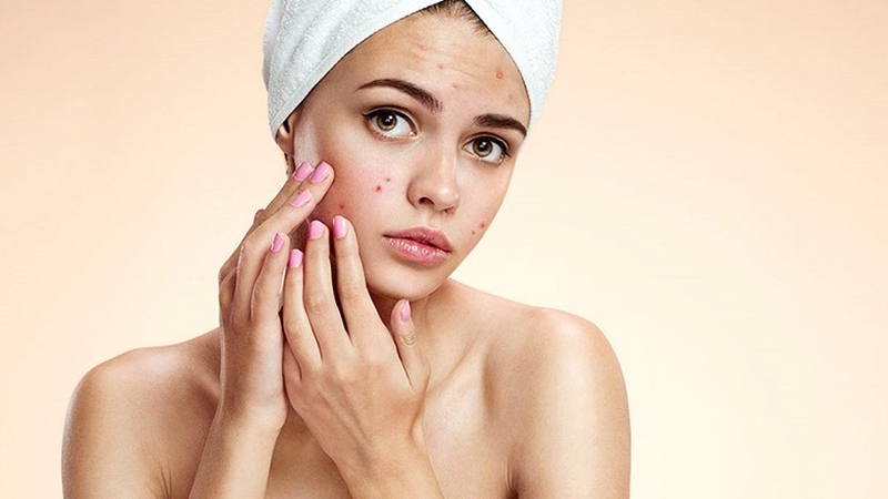 Giải đáp thắc mắc: Hiruscar Post Acne có trị mụn không? 3