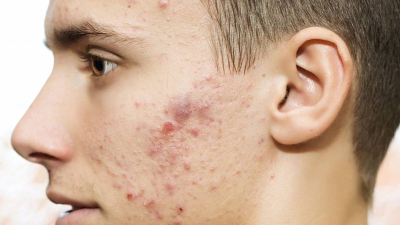 Nam giới ít khi để ý và chăm sóc da nên mụn sẽ ngày càng ảnh hưởng nhiều đến sức khỏe và ngoại hình