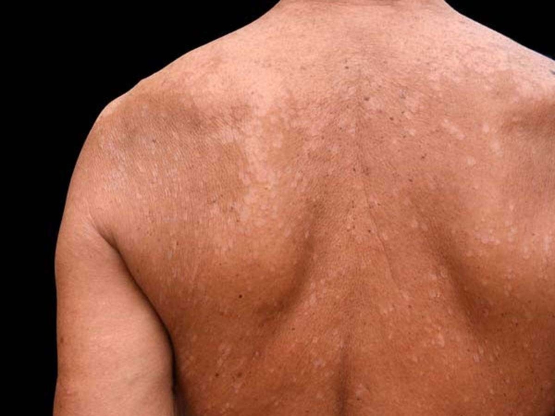 Lang ben sẽ không gây ra nhiều nguy hiểm cho người bệnh nhưng nó lại khiến nhiều người e dè, thiếu tự tin trong quá trình sinh hoạt